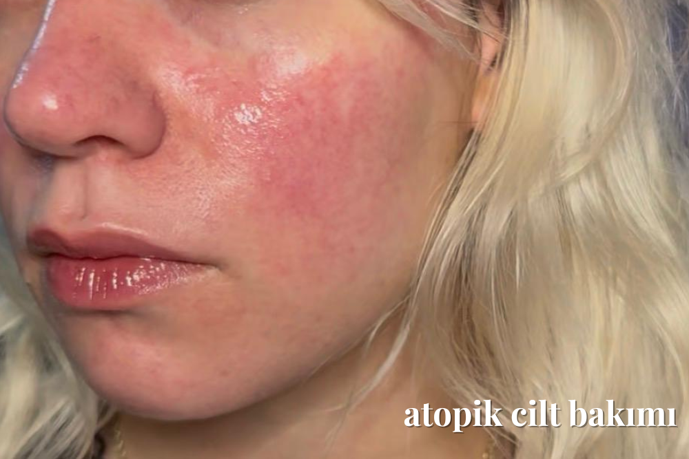 Atopik Dermatit Nedir? | Magic Company & Co
