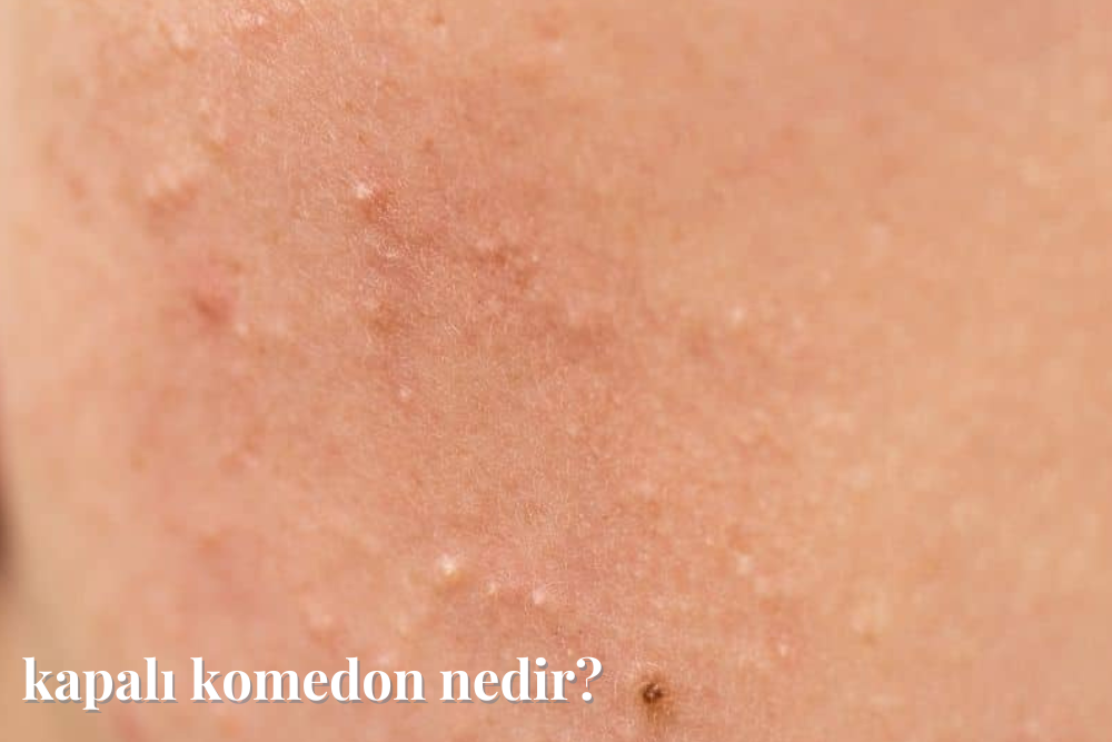 Komedon Nedir? Komedon Nasıl Geçer? | Magic Company & Co