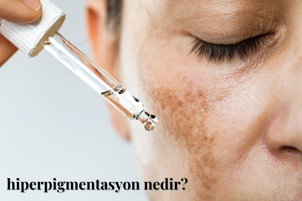 Hiperpigmentasyon