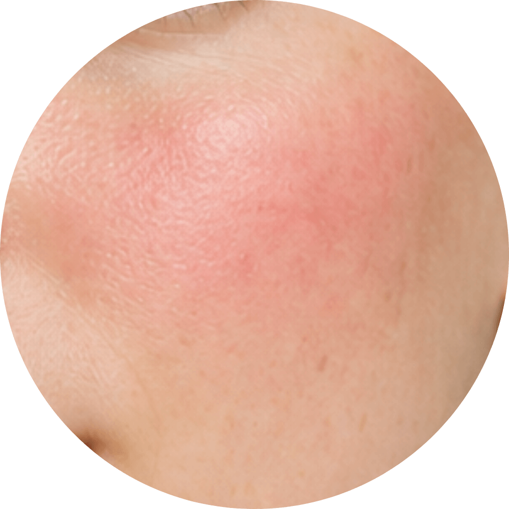 Kızarıklık Görünümü