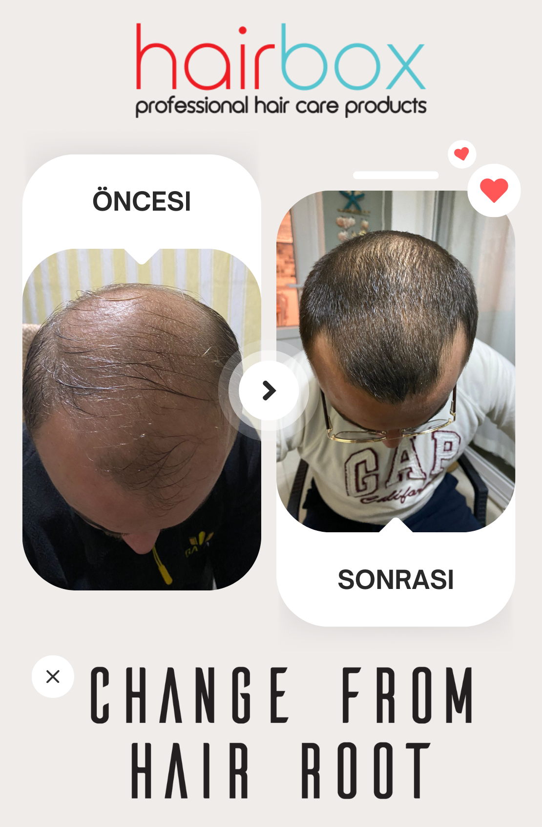 Hairbox Erkek Saç Serumu ( 3 Adet Serum + 1 Adet Dermaroller + 1 Adet Şampuan)