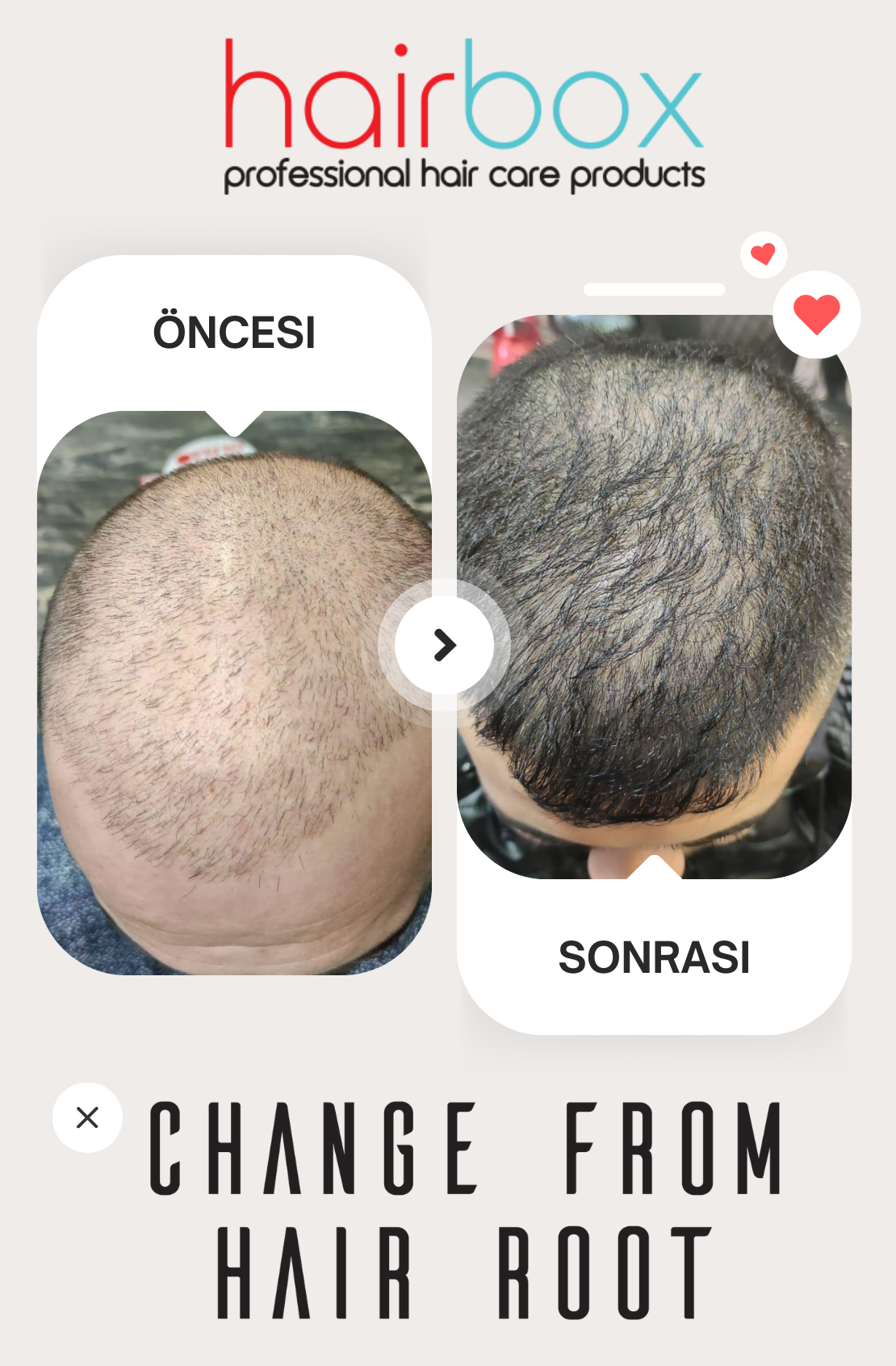 Hairbox Erkek Saç Serumu (3 Adet Serum + 1 Adet Dermoroller Hediye)