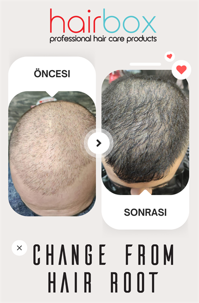 Hairbox Erkek Saç Serumu (3 Adet Serum + 1 Adet Dermoroller Hediye)