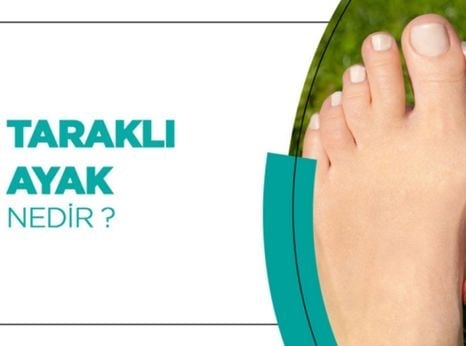 Taraklı ayak nedir