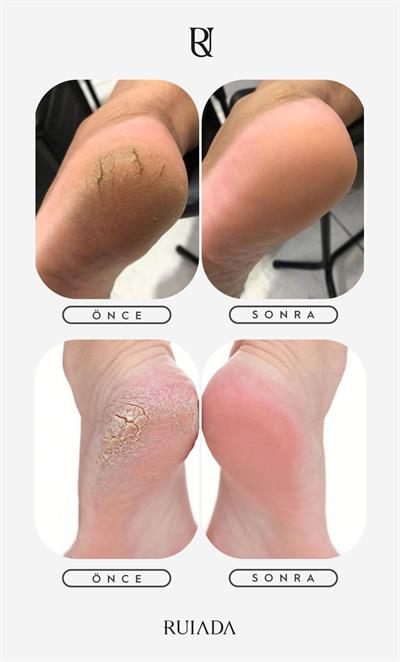 +100 Factor Topuk Kesesi %100 Floş İpek El Dokuması