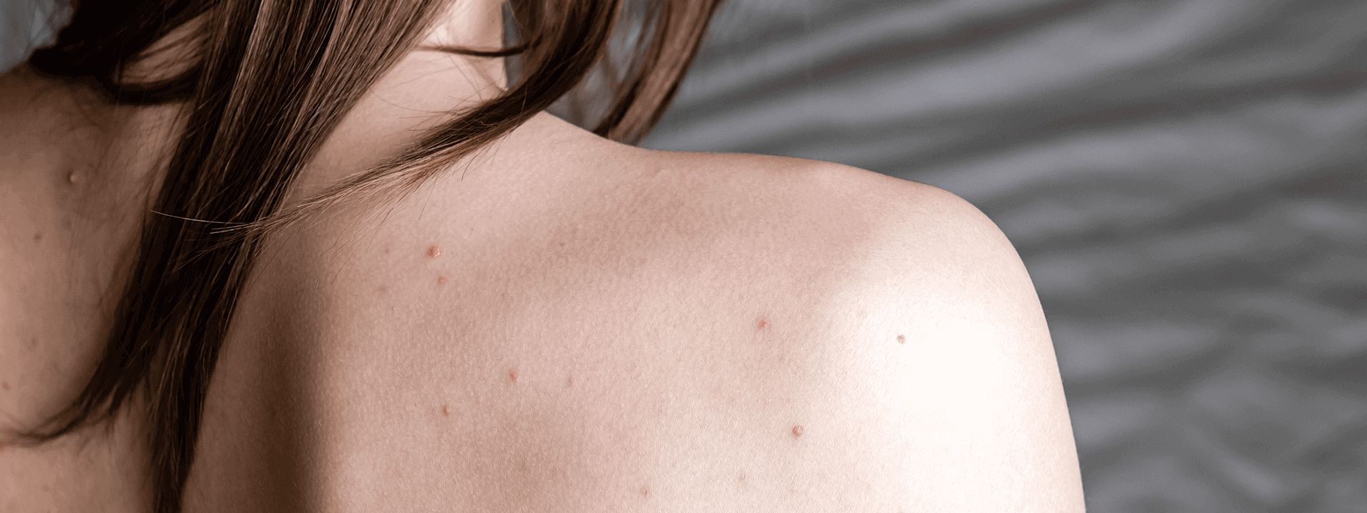 Sırtta Neden Sivilce (Akne) Çıkar? | Propia