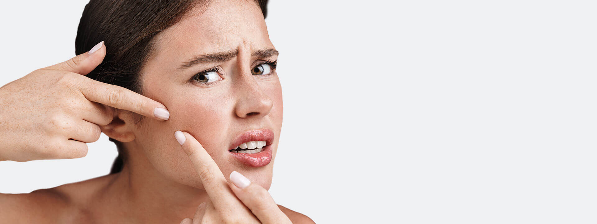 Sivilce (Akne) Türleri Nelerdir? | Propia