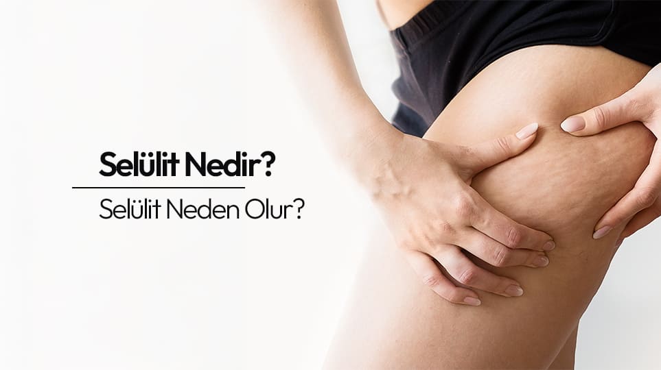 Selülit Nedir? Selülit Neden Olur?