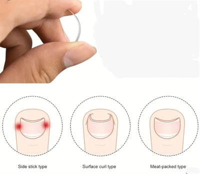 BAŞ PARMAK TIRNAK BATMASINI ENGELLEYEN METAL APARAT NRD 603 ***