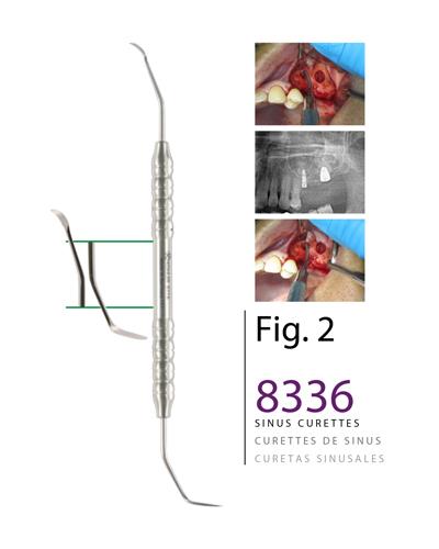 Sinüs Lifting Aleti