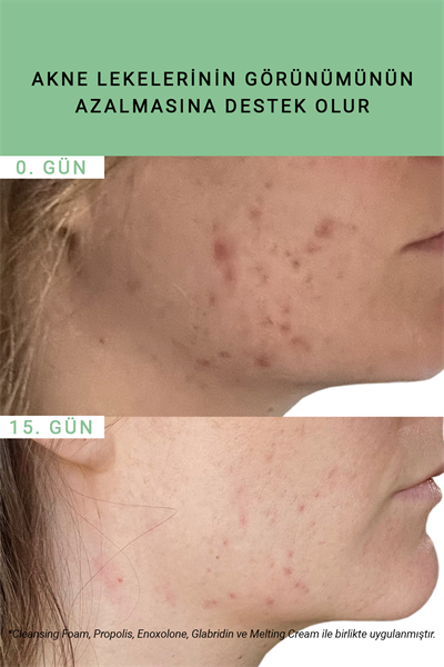 Pure Active Propolis Akne Karşıtı Saf Konsantre Bakım Serumu 15 ml