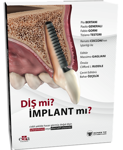 Diş mi? İmplant mı? (Doğal Dişin Korunması veya İmplant Çözümleri Üzerine Kapsamlı Rehber)
