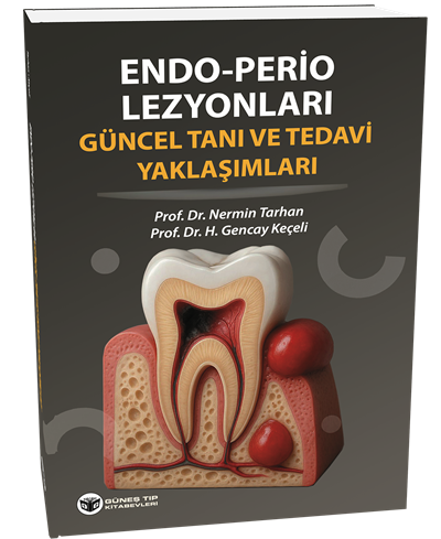 Endo - Perio Lezyonları Güncel Tanı ve Tedavi Yaklaşımları