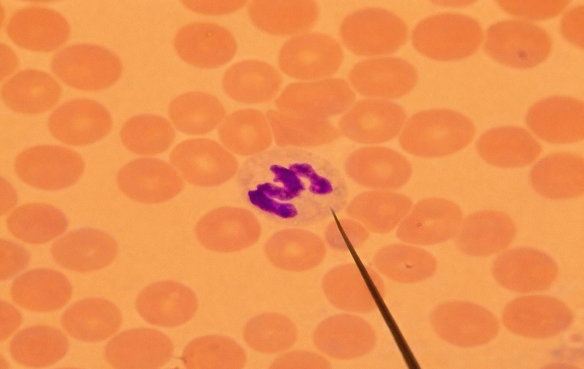 Hemoglobinopati Tanısında Mikroskobik Boyama Tekniklerinin Önemi