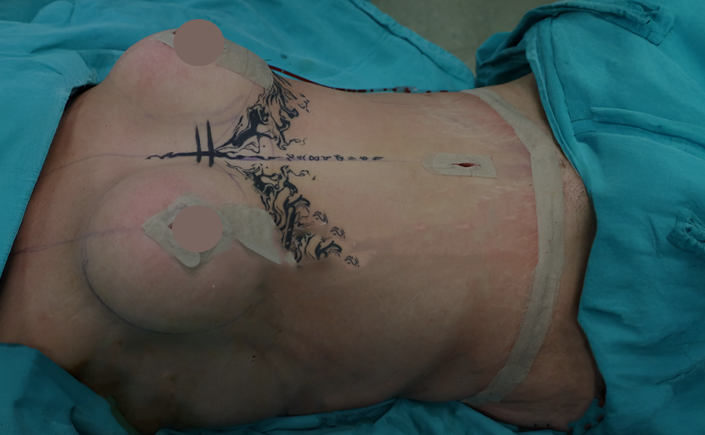 After - Patient 1
