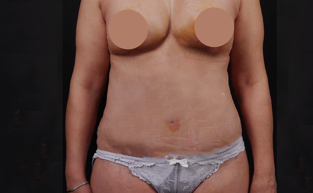After - Patient 3