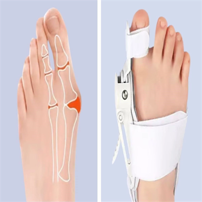 Ayarlanabilir Ayak Baş Parmak Kemik Düzeltici – Halluks Valgus (bunyon) Aparatı, Gece Gündüz Kullanıma Uygun Ayak Düzeltme Ateli Bx40