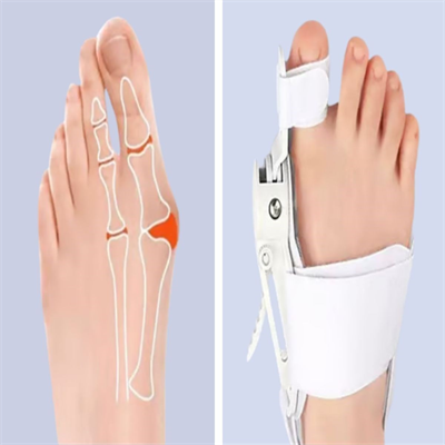 BUFFER® Ayarlanabilir Ayak Baş Parmak Kemik Düzeltici – Halluks Valgus (Bunyon) Aparatı, Gece Gündüz Kullanıma Uygun Ayak Düzeltme Ateli