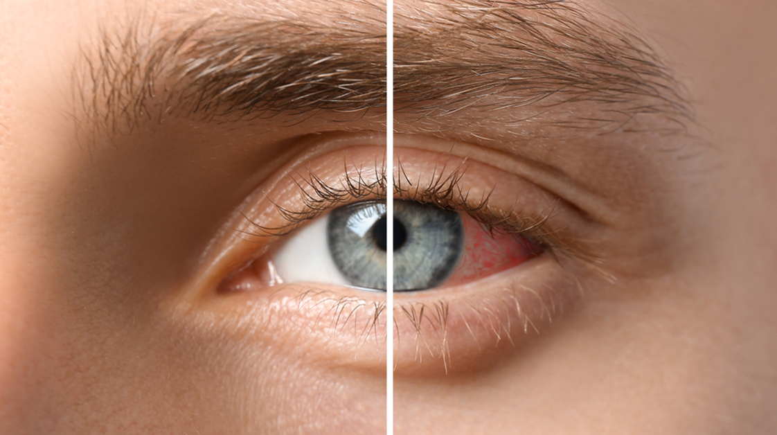 Renkli Lensler Gözde Batma Yapar mı? Sorunlar ve Çözümler