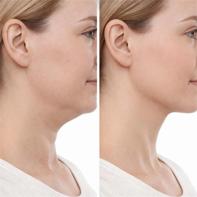 Lenfatik Drenaj Masaj Fırçası