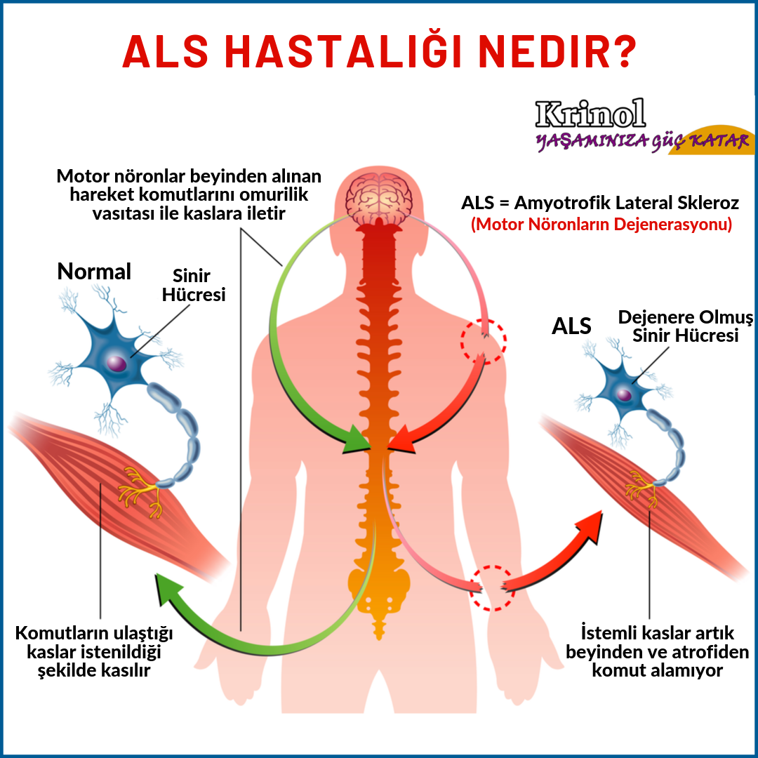 ALS Hastalığı Nedir?