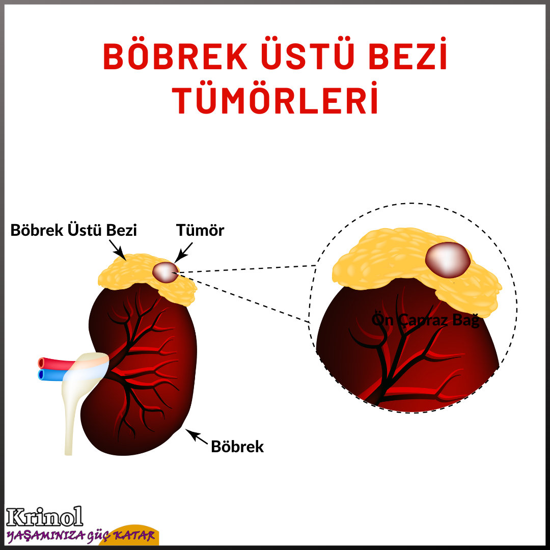 Adrenal Üstü Bezi Tümörleri