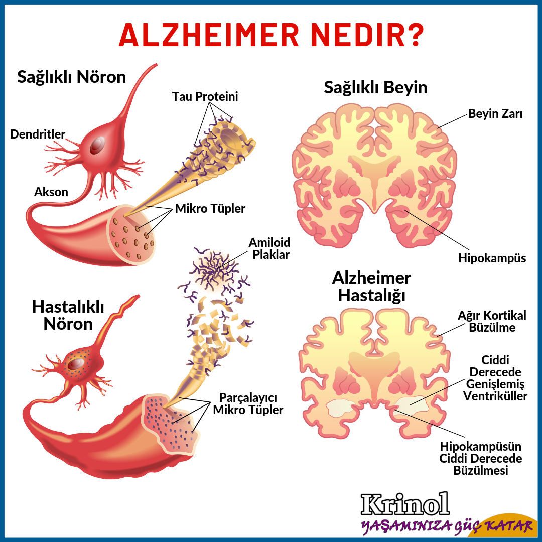 Alzheimer Nedir?