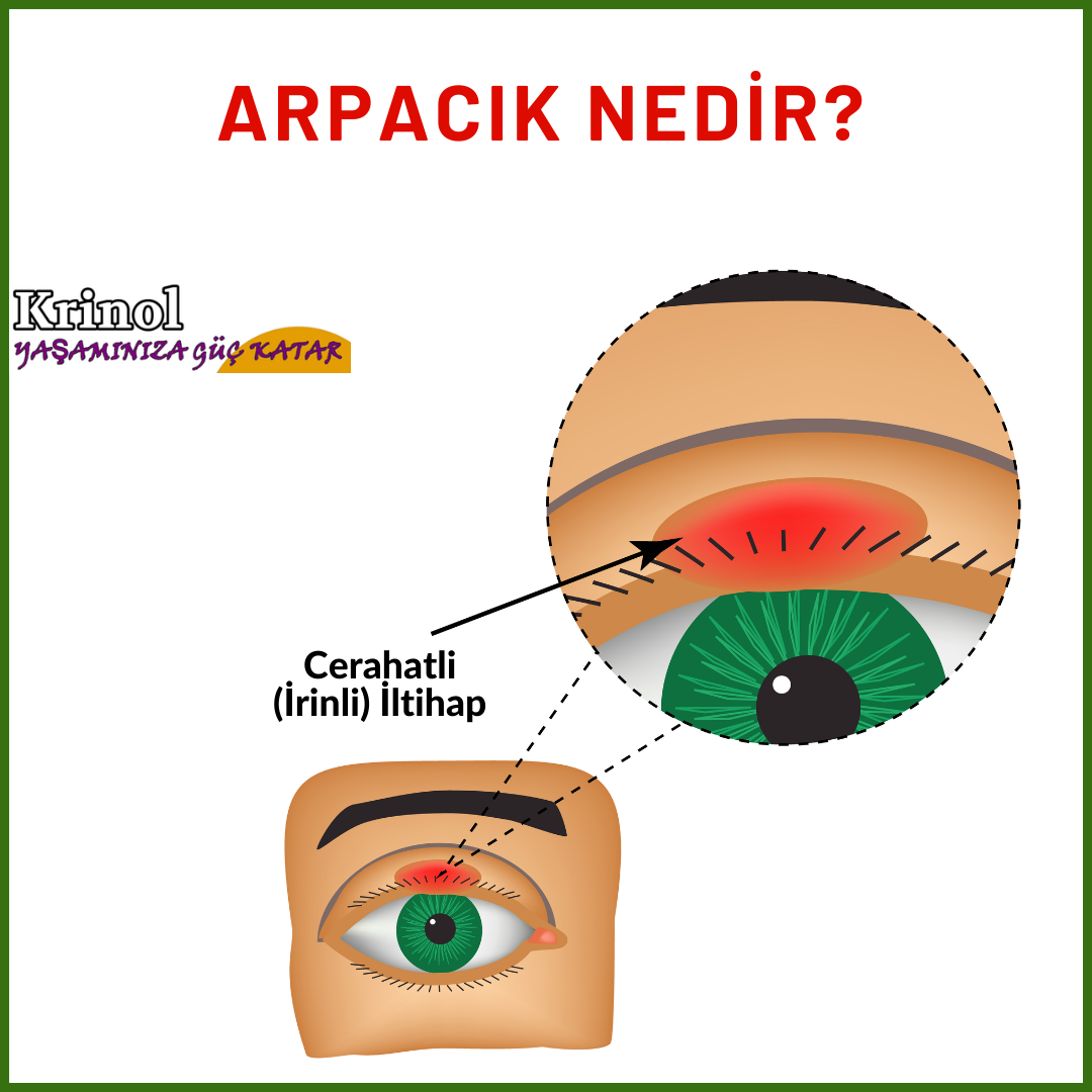 Arpacık Nedir?
