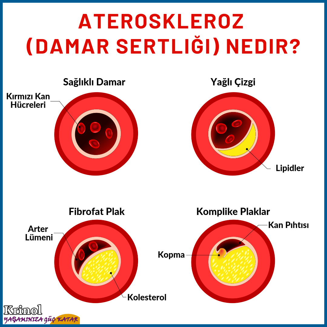 Ateroskleroz (Damar Sertliği) Nedir?