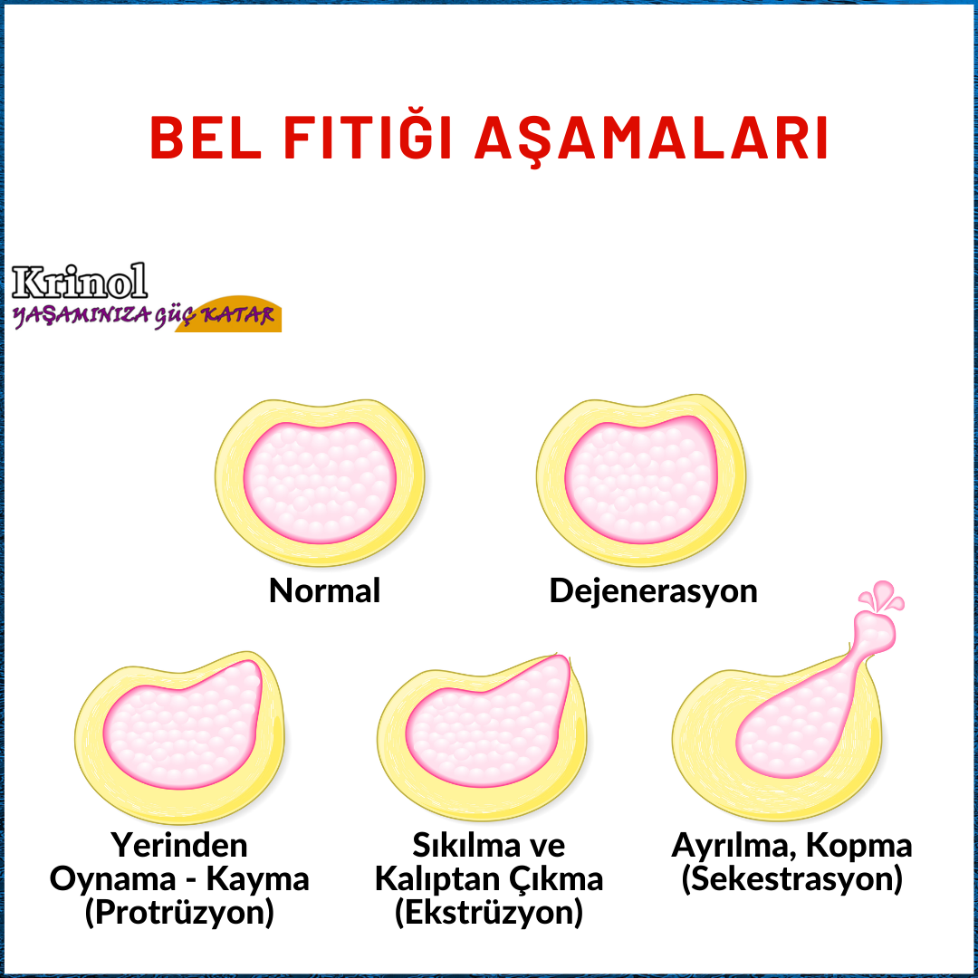 Bel Fıtığı Aşamaları Nelerdir?