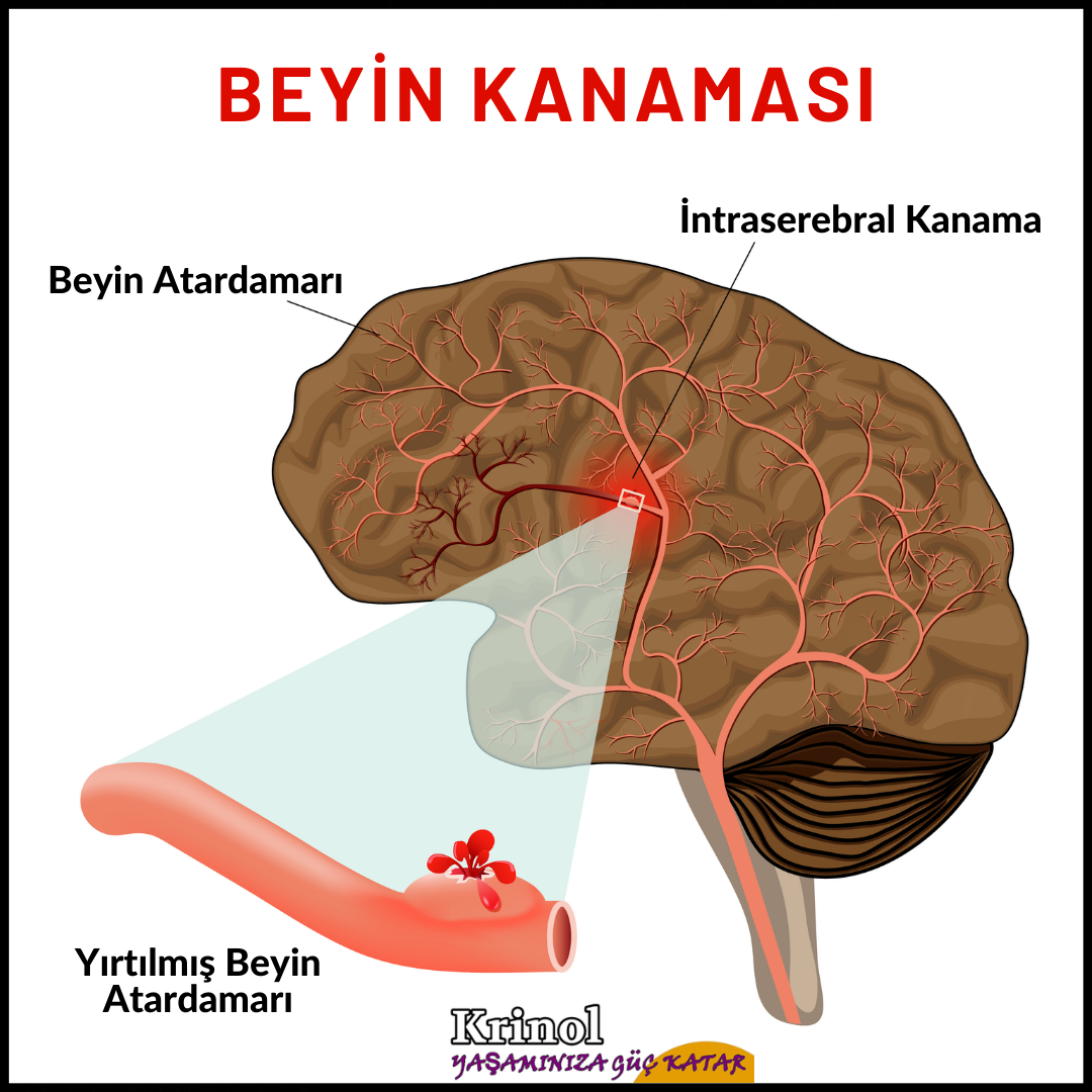 Beyin Kanaması Nedir?