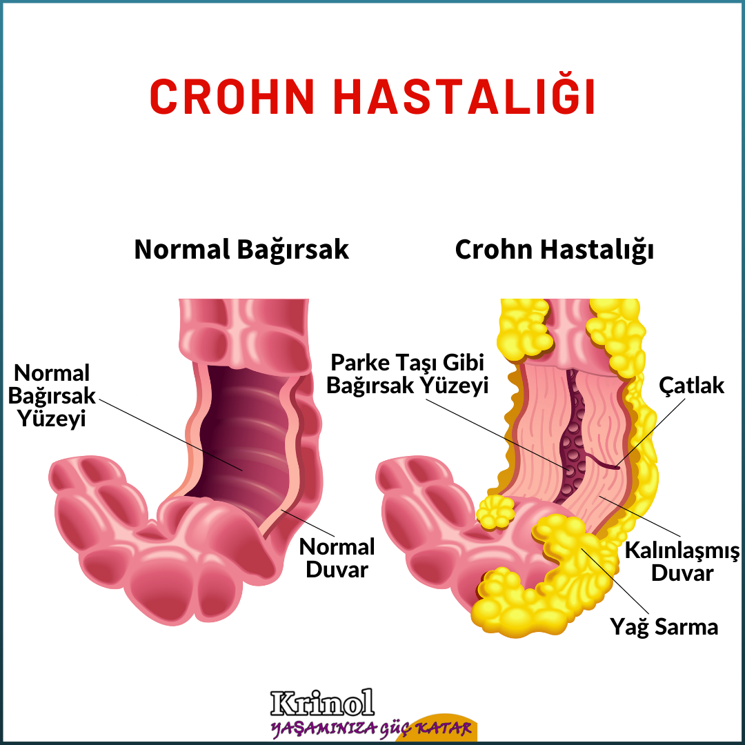 Crohn Hastalığı Nedir?
