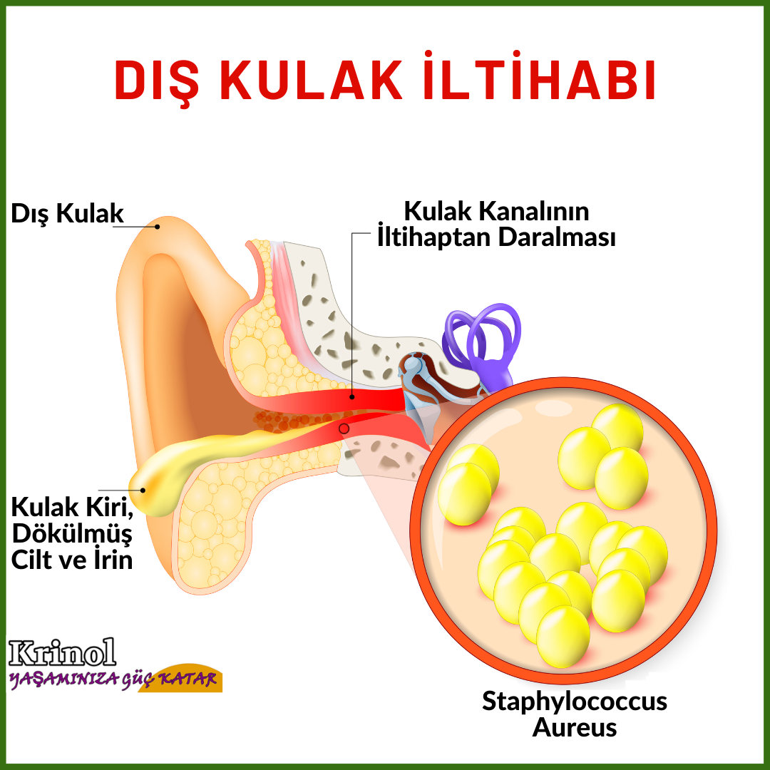Dış Kulak İltihabı Nedir?