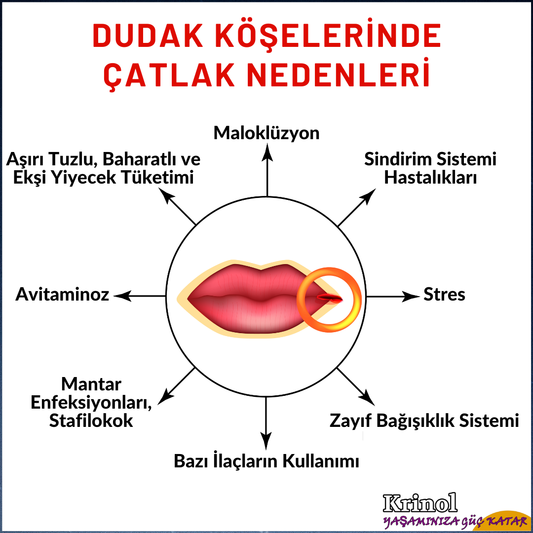 Dudak Köşelerinde Çatlak Nedenleri Nelerdir?