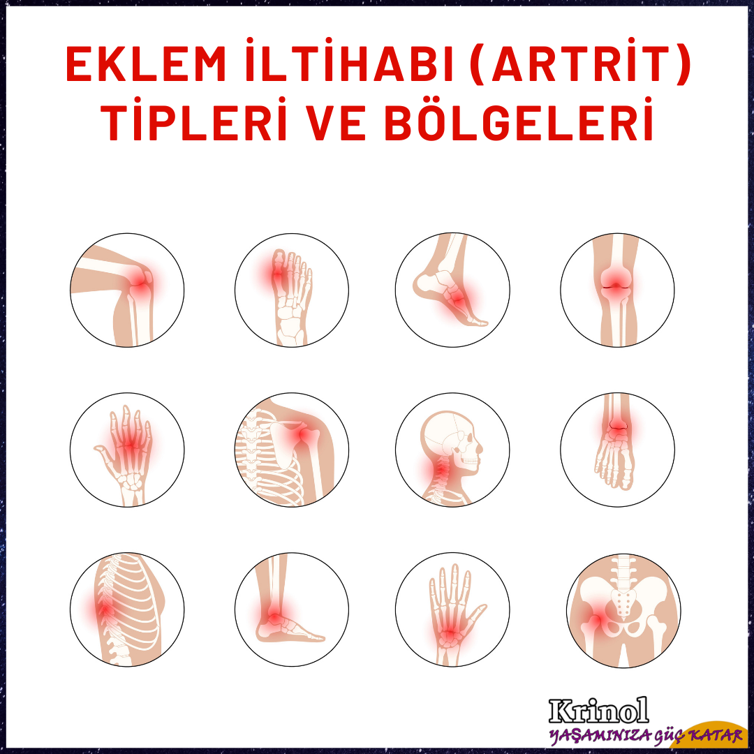 Eklem İltihabı (Artrit) Tipleri ve Bölgeleri Nelerdir?