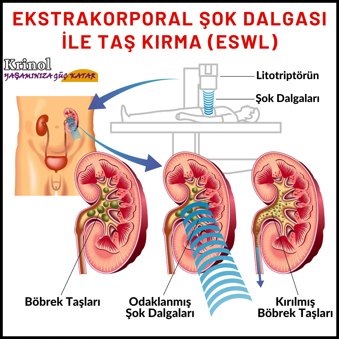 Ekstrakorporal Şok Dalgası İle Taş Kırma (ESWL) Nedir?