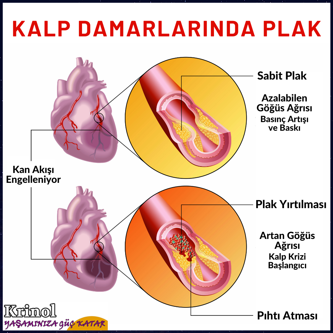 Kalp Damarlarında Plak Nedir?