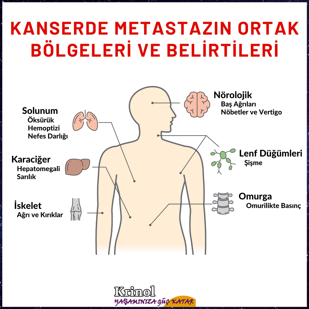 Kanserde Metastazın Ortak Bölgeleri ve Belirtileri Nelerdir?