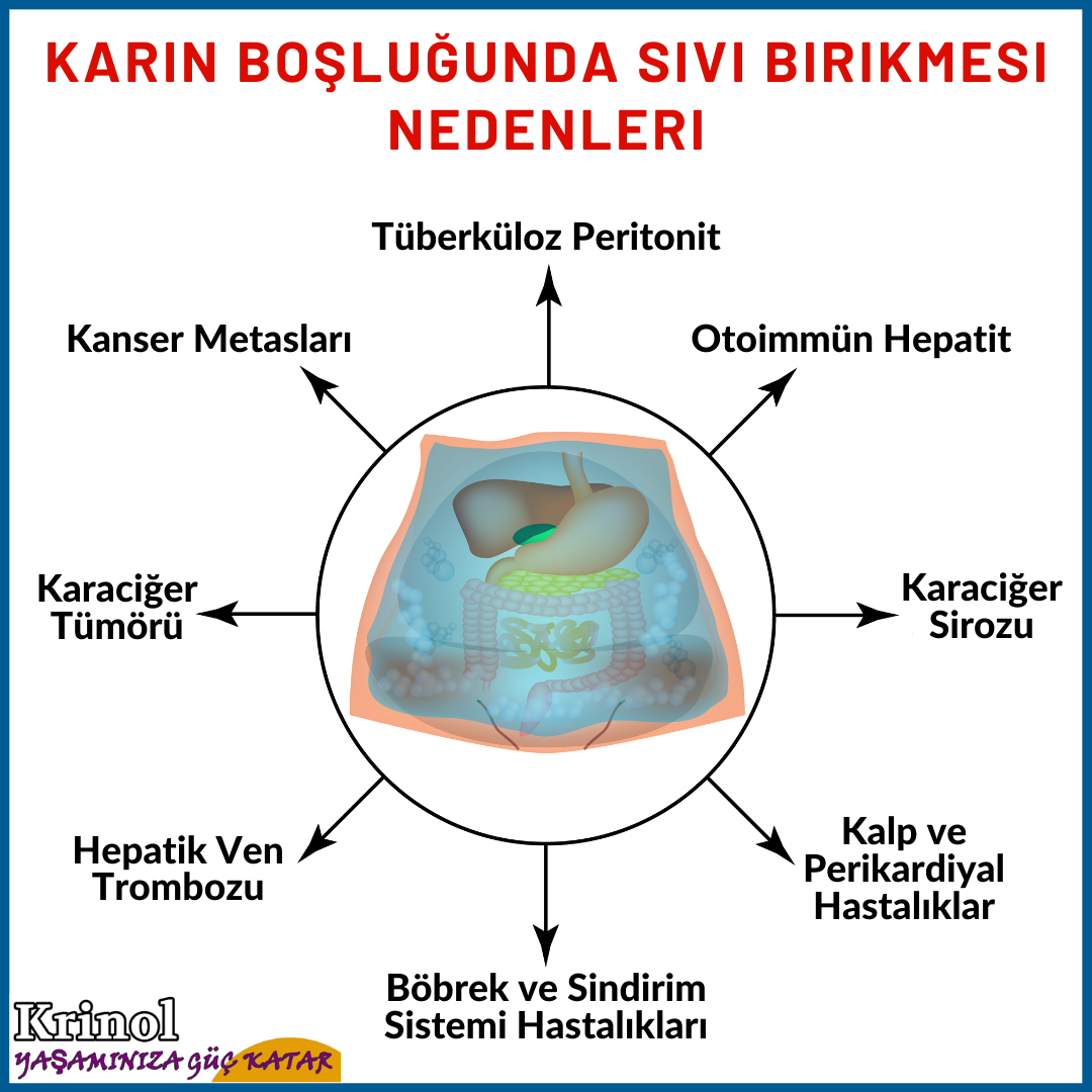Karın Boşluğunda Sıvı Birikmesi Nedenleri Nelerdir?