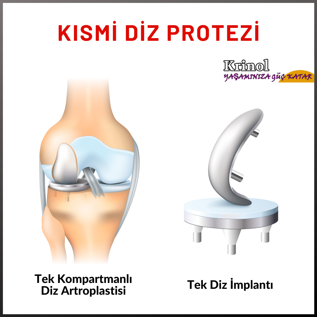 Kısmi Diz Protezi Nedir?