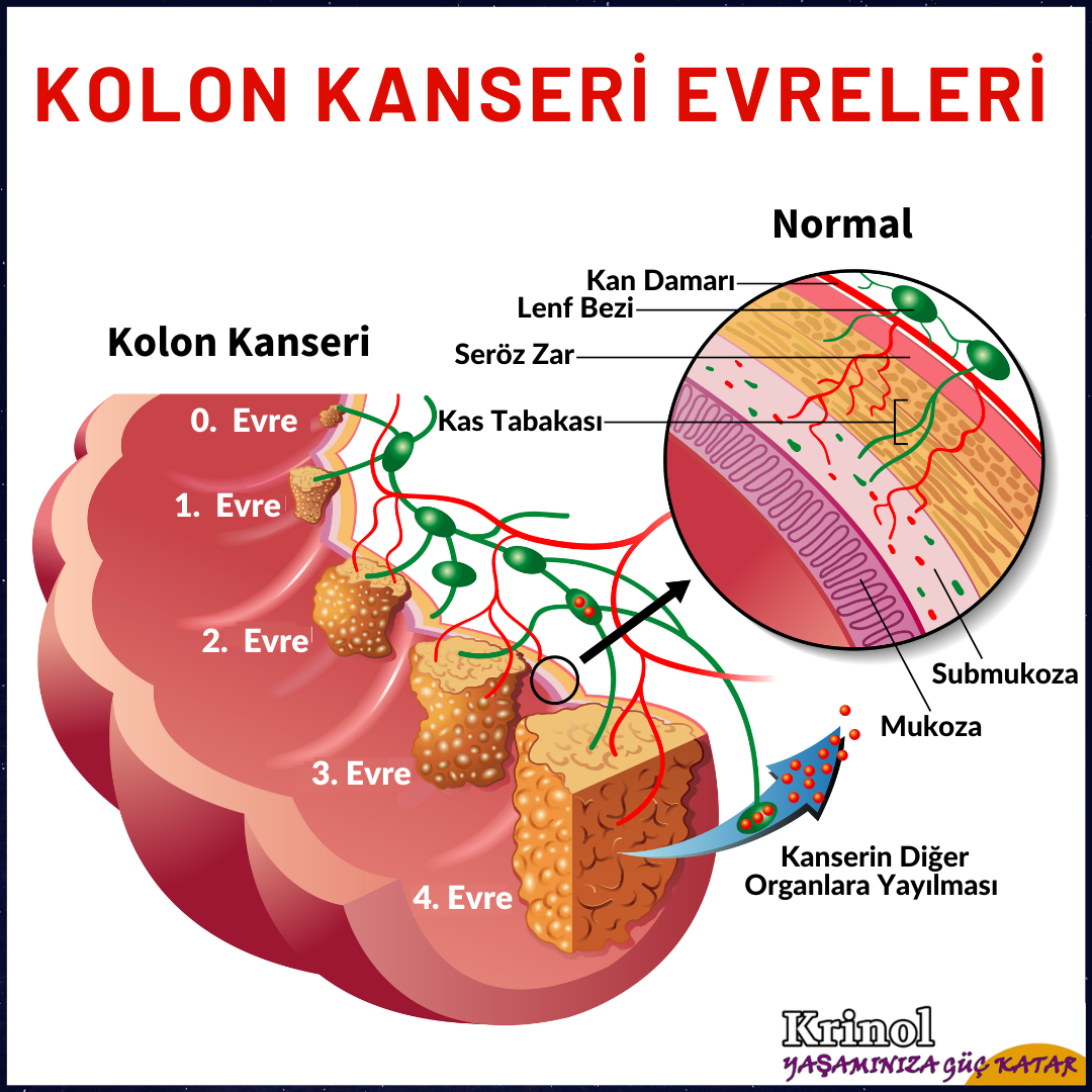 Kolon Kanseri Evreleri Nelerdir?