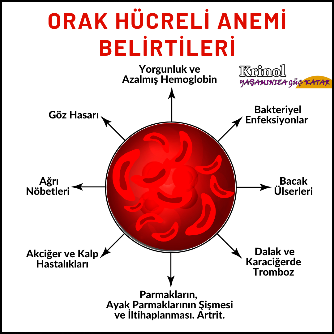 Orak Hücreli Anemi Belirtileri Nelerdir?