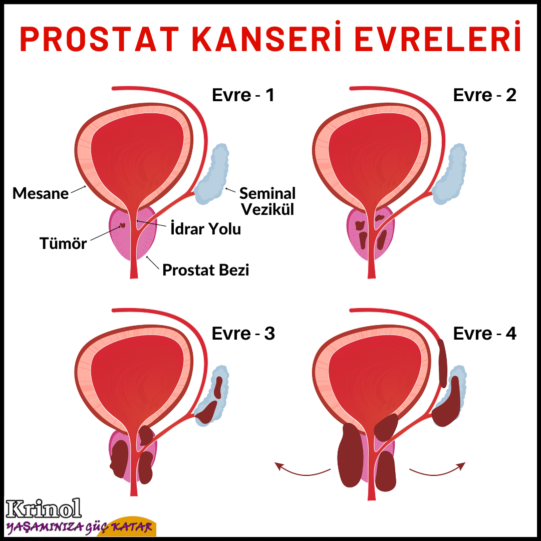 Prostat Kanseri Evreleri Nelerdir?