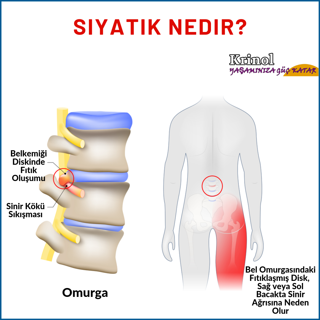 Siyatik Nedir?