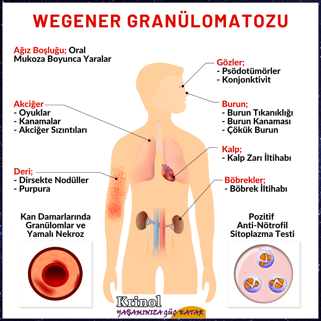 Wegener Granülomatozu Nedir?