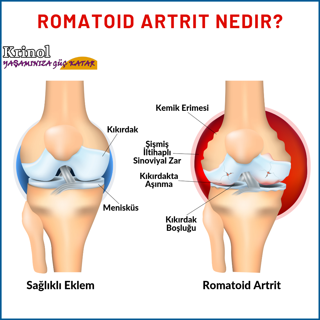 Romatoid Artrit Nedir?