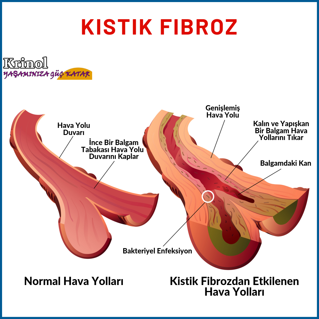 Kistik Fibroz Nedlr?
