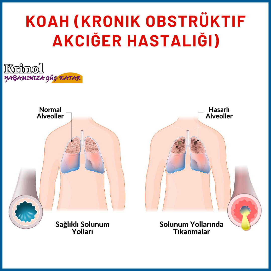 KOAH (Kronik Obstrüktif Akciğer Hastalığı) Nedir?