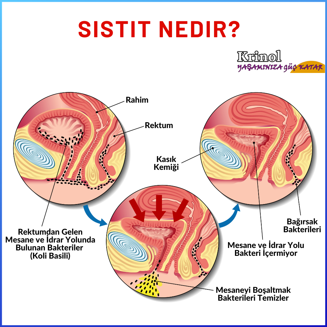Sistit Nedir?
