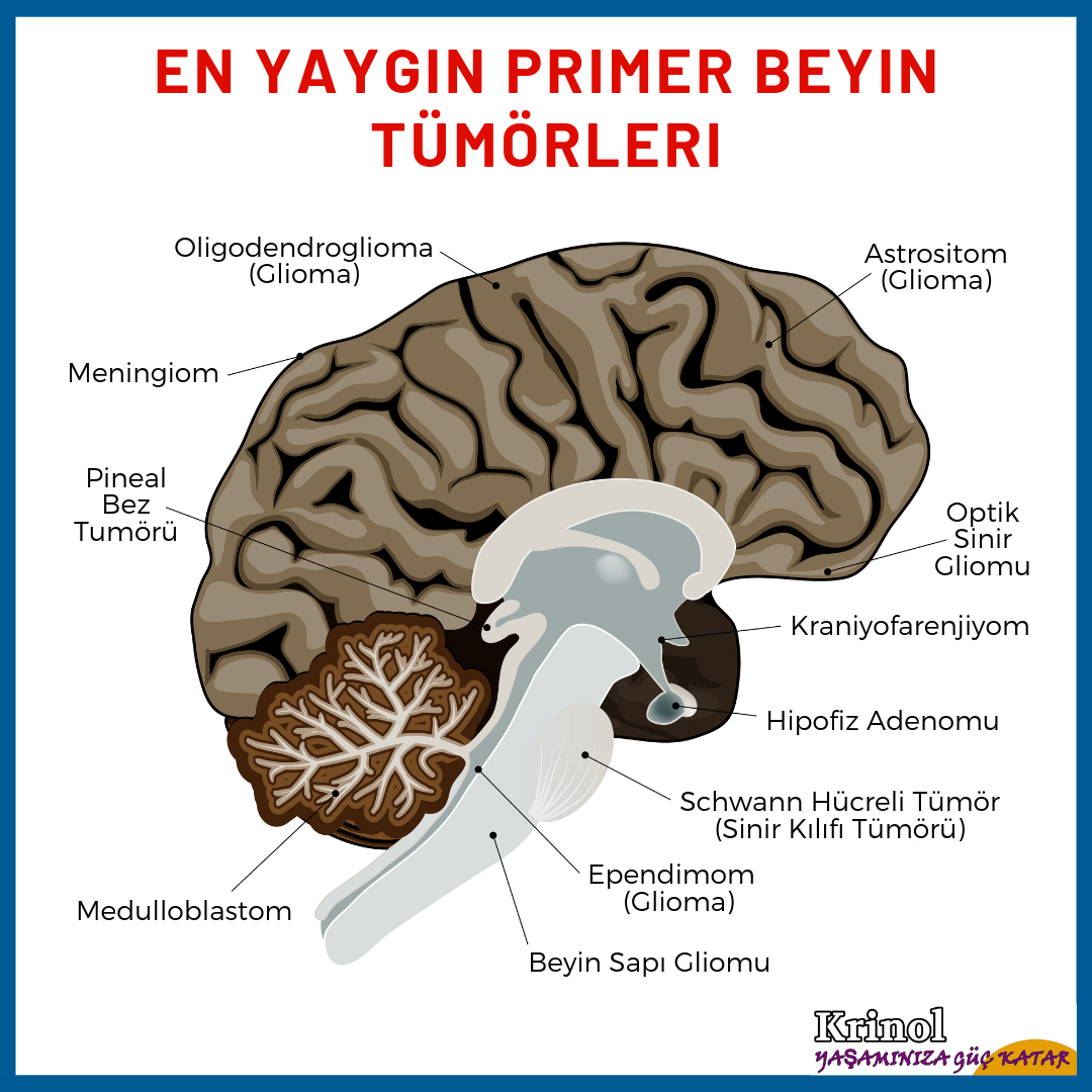 En Yaygın Primer Beyin Tümörleri Nelerdir?